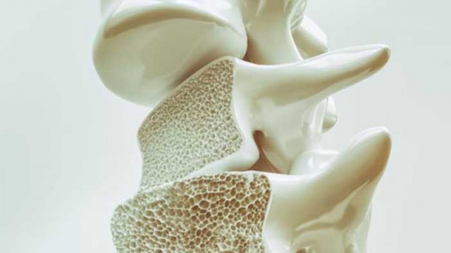 Всеки четвърти е диагностициран с намалена костна плътност или остеопороза