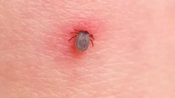 Два случая на Лаймска болест за изминалата седмица във Варна