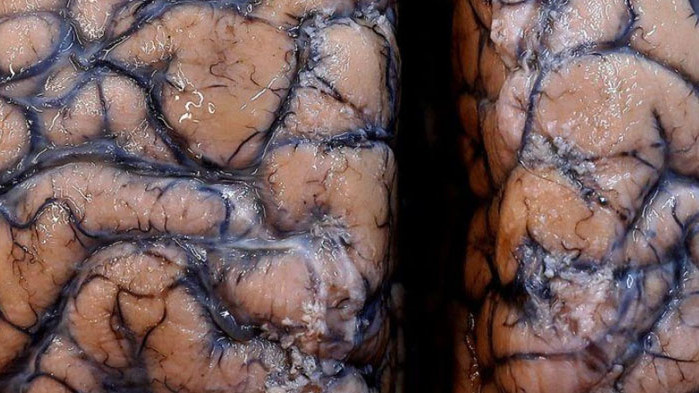 COVID-19 причинява сериозни мозъчи увреждания и неврологични изменения