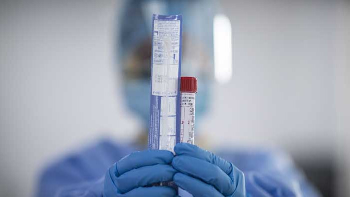 Кой умира и кой оцелява при COVID-19